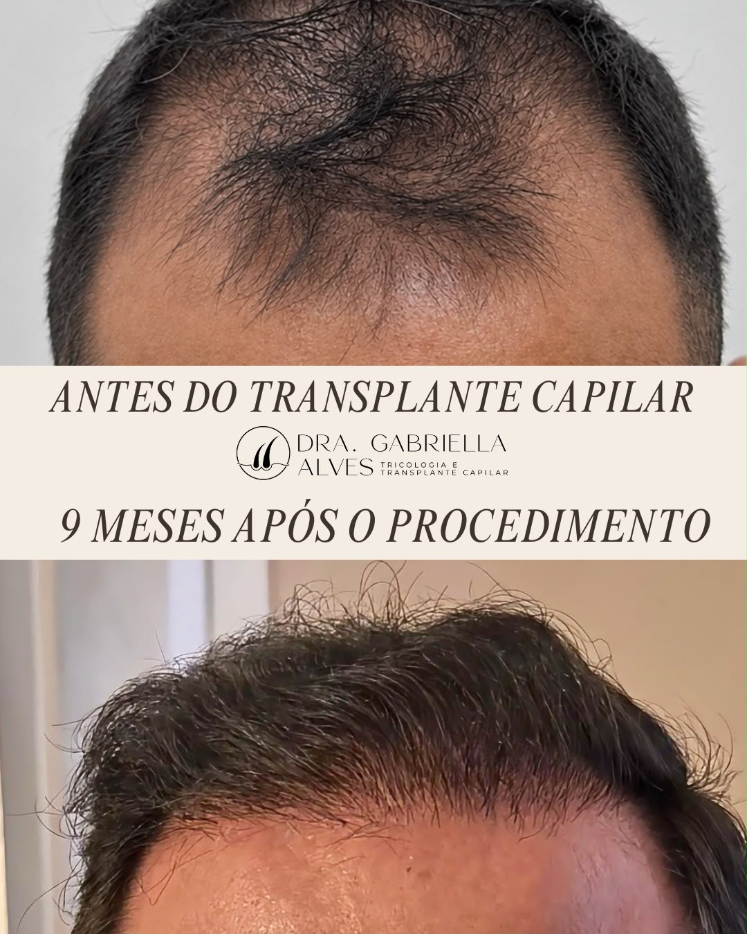 Comparativo antes do transplante capilar e nove meses após o procedimento