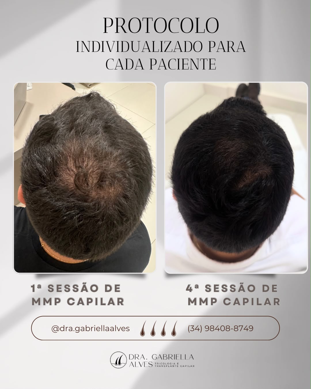 Comparativo entre a primeira e a quarta sessão de MMP capilar